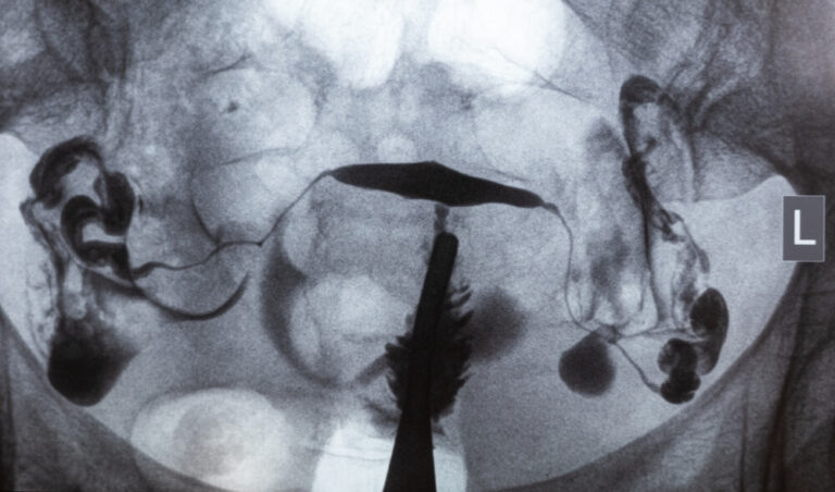 Image d’hystérosalpingographie montrant l’utérus et les trompes de Fallope après injection de produit de contraste – examen radiologique permettant d’évaluer la perméabilité tubaire dans le cadre d’un bilan de fertilité en AMP.
